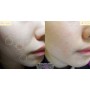 Эмульсия для проблемной кожи Ciracle Anti Blemish Spot Emulsion
